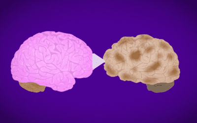 Experimental drug appears to slow progression of Alzheimer’s disease in clinical trial but raises safety concerns