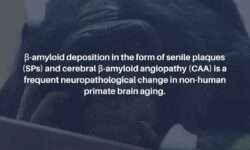 Brain Aging and Alzheimers